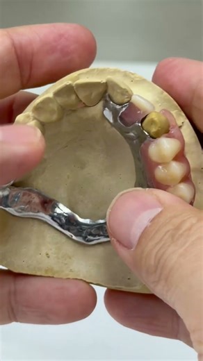 Chrome cobalt partial with acrylic, metal clasps and framework!