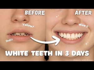 How I got WHITE TEETH in just 3 Days 🌸 || Beauty with Brain