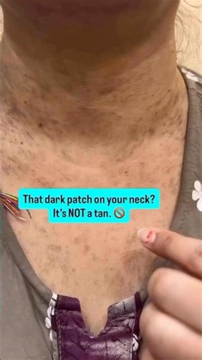 Why Your Neck Has Grey-Brown Patches (It’s NOT a Tan) | LPP Laser Treatment #skincare