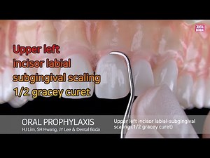 Upper left incisor labial subgingival scaling 1/2 gracey curet