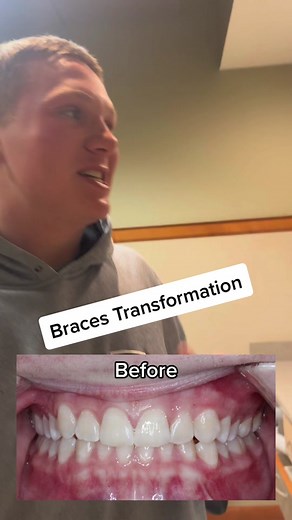 Amazing Braces Transformation Before & After