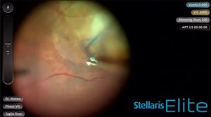 [3-D] Choosing Techniques for ILM Peel: Why the Dye Staining Pattern Might Matter - Eyetube