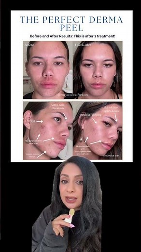 These before and after results are after just one Perfect Derma™ Peel treatment 🥰