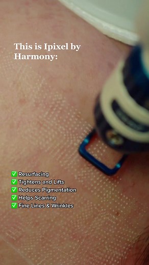 Ipixel by Harmony XL PRO iPixel skin-resurfacing laser treatment helps to improve skin texture, tone and pore size, and reduces or removes the appearance of marks and blemishes. Compared to older resurfacing laser technologies, iPixel is part of the new generation of non-ablative, fractional lasers that give superior results with less downtime. The iPixel is an effective treatment for: scarring acne scarring hyperpigmentation ageing skin sun damage and stretch marks.