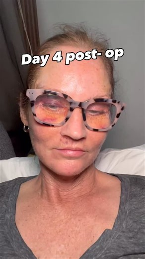 Patsy Russell on Instagram: "Day for post-op from the Guadalajara revision upper and lower blef, lip lift and brow lift. #faceliftguadalajara #twinfaceliftdiaries"
