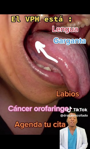 Papiloma escamoso por VPH: Causas y Contagio
