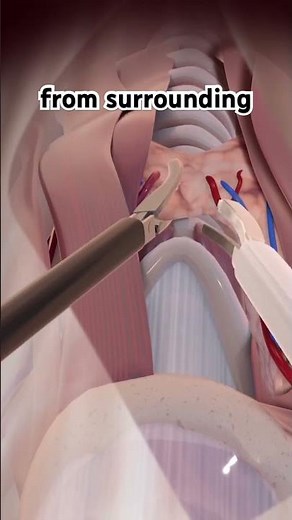 How Thyroidectomy Is Done (3D Animation) #thyroid#thyroidectomy#thyroidsurgery#3dmedicalanimation