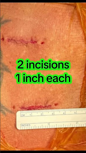 Outpatient L4-L5 Minimally Invasive Lumbar Fusion Review