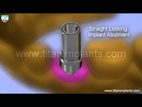 Open Tray and Final Restoration Technique for Biomet 3i Internal Connection Compatible System