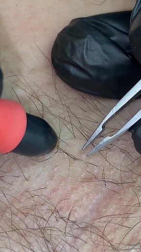 Hair Follicles Close-Up: Tweezing Techniques Explained