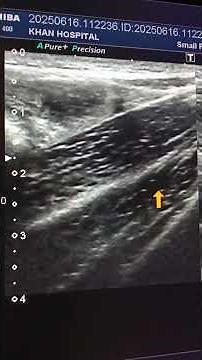 Undescended Testicles in a 2-Year-Old | Ultrasound Findings Explained