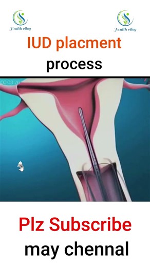 IUD placment process #pregnant #fetus #IUD #placement #ultrasound #pregnancy #doppler #baby