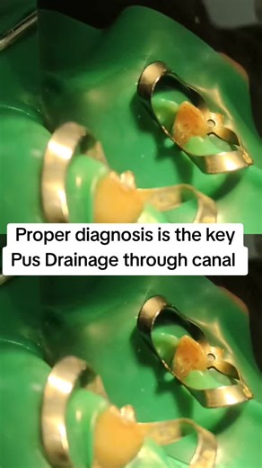 Pus Drainage Through Canal in Dental Treatments