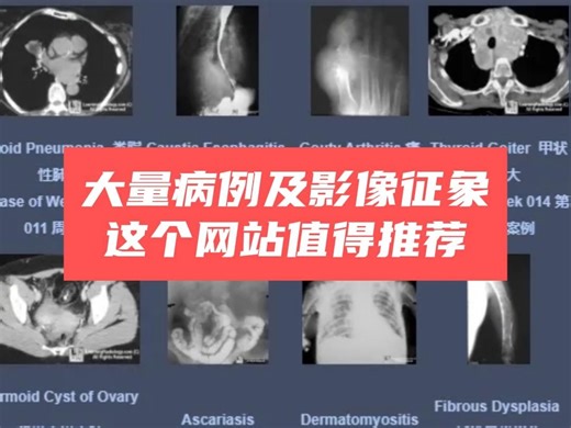 新手如何学习影像？想学习各种影像学征象？看这里！