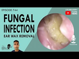 744 - Fungal Ear Infection Ear Wax Removal