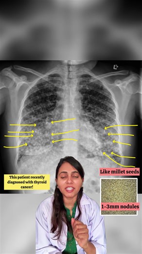 🫁 Chest X-ray: Miliary Metastases (Thyroid Cancer) 📸 Key X-ray findings \t•\tDiffuse, bilateral micronodules (1–3 mm) throughout both lung fields \t•\tUniform distribution from apices to bases → classic miliary pattern \t•\tWell-defined tiny nodules giving a “sand-like” appearance \t•\tNo zonal predominance (unlike TB which may be upper-zone dominant) \t•\tNormal cardiac size (helps differentiate from pulmonary oedema) \t•\tMay coexist with normal or minimally abnormal CXR early on ⚠️ Importan