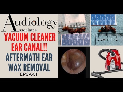 VACUUM CLEANER EAR WAX REMOVAL - EP601