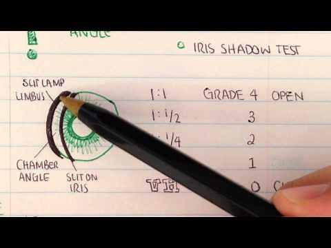 Gonioscopy- Anterior chamber assessment