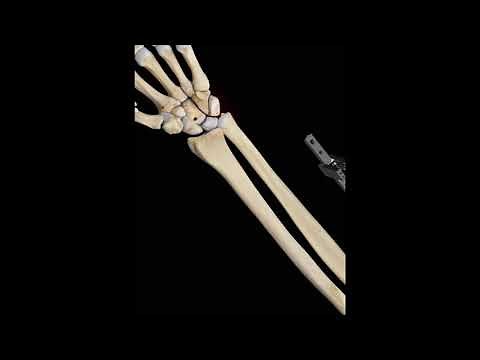 Ulnar Shortening Osteotomy - 3D Medical Animation