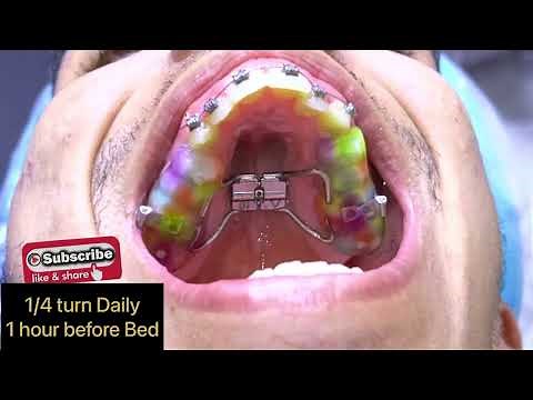 Orthodontic Expander (Bonded Hyrax) How it works ? جهاز توسيع الفك العلوي تقويم الأسنان للكبار