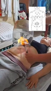 🔥 Fire cupping uses heat to create suction that lifts tissue, boosts circulation, and relieves muscle tension. It helps reduce stiffness, speed recovery, and restore mobility—great for athletes or anyone dealing with chronic tightness. #chiropractor #drkyleross #firecupping | Dr_kyleross