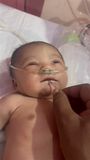 Newborn Baby NG Tube Placement in NICU | Safe Feeding Support #NewbornBaby #NGTube #NGTubePlacement