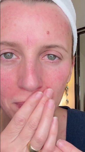 Qure At-Home Microneedling Levels Up Your Skincare!