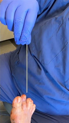 This is a cast for a toe after surgery!