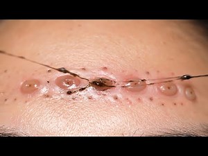 ULTIMATE Oddly Satisfying Blackhead Cluster Extraction! 🤯✨