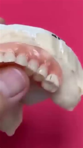 2.6K views | Explore various denture types designed to replace missing teeth effectively. Learn more | The Service Club | Facebook