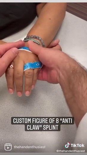 Custom Anti Claw Figure of 8 Splint for Hand Therapy