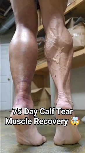 75 Day Calf Tear Muscle Recovery