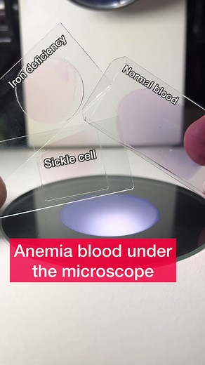 Understanding Anemia: Causes and Treatments Explained