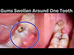 Why is my gums swollen around one tooth ?