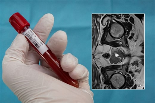 Prostate cancer: NHS denies life-saving checks for most men — putting 1,500 lives at risk