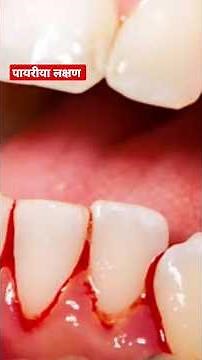 pyria symptoms | pyorrehea treatment at home #shorts #shwetzhealthstudio