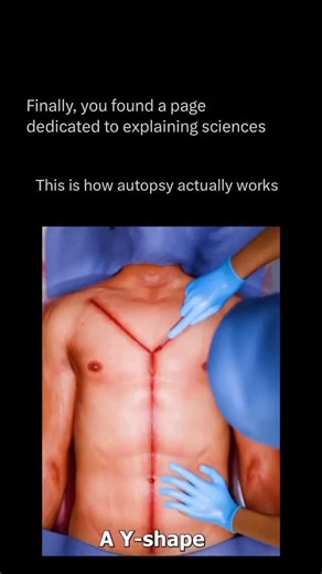 Explaining All Sciences on Instagram: "Follow @xplainingscience to learn everything about science, one post at a time 💣🧠 An autopsy is a detailed medical examination of a deceased body performed to determine the cause and manner of death, often carried out by a forensic pathologist. The process begins with an external inspection for signs of injury, disease, or unusual features, followed by an internal examination through a Y-shaped incision to study major organs like the heart, lungs, liver,