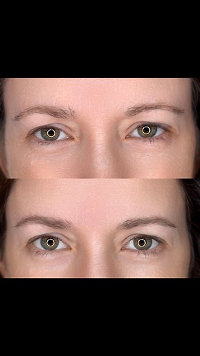 Wake-up with perfect eyebrows! Permabrows - Hyperrealistic nano-needle color infusion created by means of color gradient, light, and dark shadows without defined contours. As a result, eyebrows look full, symmetrical and at the same time very natural. Permabrows eyebrows can last 1-3 years before gradually fading away through lighter brown shades. Unlike microblading, this procedure is very gentle to the skin, does not create scarring, can be done on all skin types (even the most sensitive and s