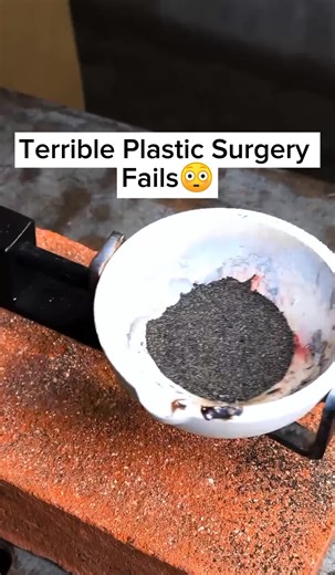 Terrible Plastic Surgery Fails and Their Unexpected Results