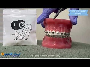 Class III (3) Vertical Elastics