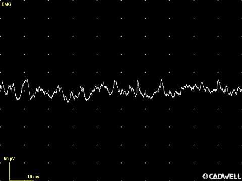 EMG teaching video 14: Endplate noise and spikes