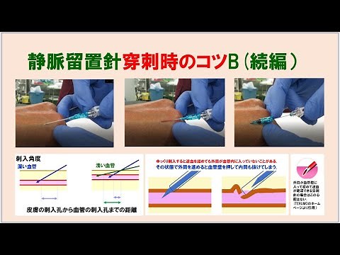 (6分52秒）静脈留置針穿刺入時のコツB（続編）
