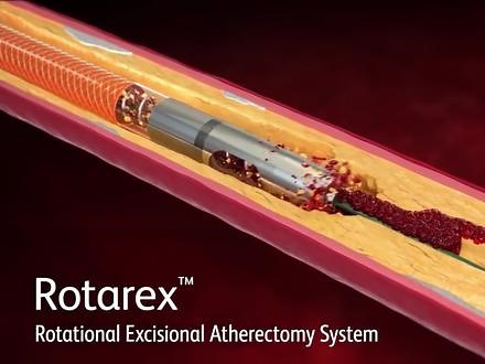 #血栓抽吸导管#医学科普#生命科学 #医疗器械美国BD公司Rotarex旋转切割刮除动脉创口系统