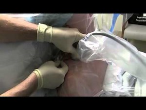 Ultrasound-guided Continuous Interscalene Block