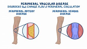 Video: Caring for Patients with Vascular Problems - Video Explanation! | Osmosis | Osmosis
