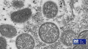 WHO declares global health emergency as cases of monkeypox spread rapidly