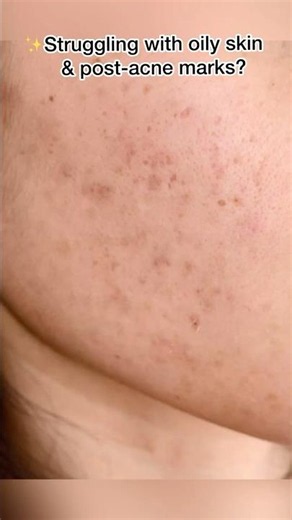 The Best Serum for Oily Skin? We Put Minimalist Niacinamide 10% to the Test #OilySkin #Skincare