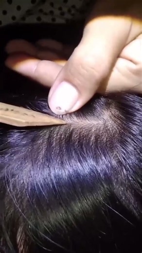 head lice #pimple #satisfying #asmrsounds #extraction #blackheads #animals
