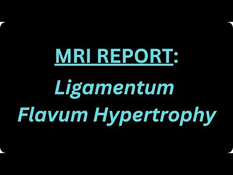 What is Ligamentum Flavum Hypertrophy?
