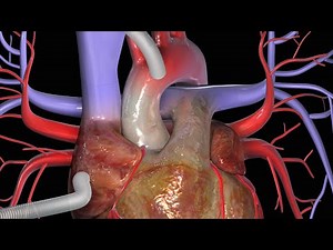 Koronararterien-Bypass (CABG)
